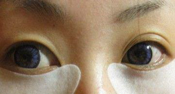 烟台毓璜顶：健康安全的割双眼皮