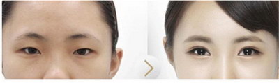 韩式内双双眼皮手术(韩式双眼皮的手术过程)