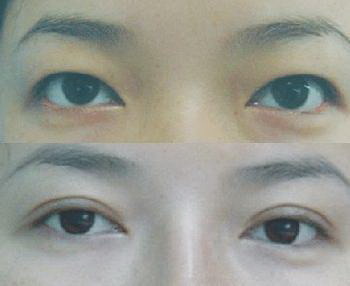 晶体植入手术后眼睛红正常吗