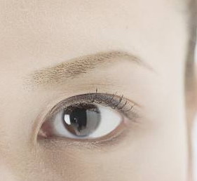 微创双眼皮手术具有哪些优点？