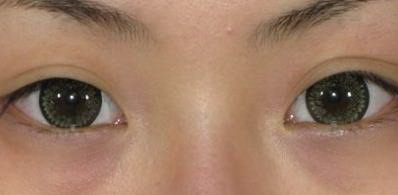 双眼皮术后很对称,恢复期不对称了【双眼皮术后恢复期反复肿胀】