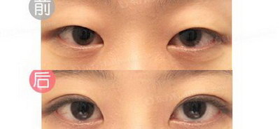 美杜莎双眼皮和全切的区别(美杜莎和全切双眼皮的区别)