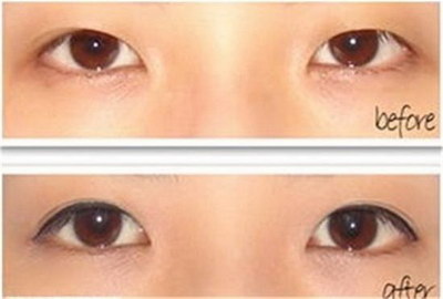 韩式埋线双眼皮术后效果好吗？
