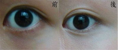 做肿泡眼双眼皮不同于其他的双眼皮