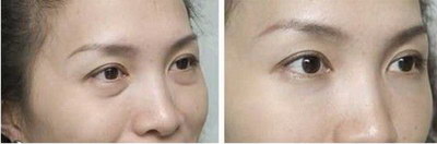 北京哪家医院割双眼皮手术比较好