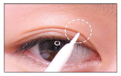 眼部汗管瘤怎么去除小偏方(眼部汗管瘤是什么？)