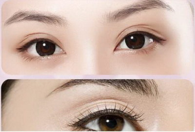 韩式双眼皮术如何成就完美眼部形态呢？