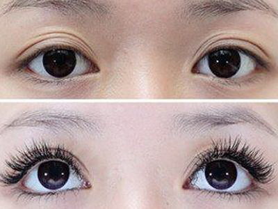埋线双眼皮大小对眼睛的影响_埋线双眼皮大小是否可调整？