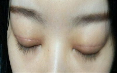 如何消除黑眼圈让眼睛美美的「如何消除黑眼圈和眼睛里的血丝」