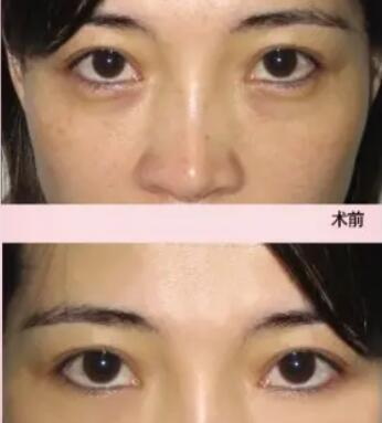 双眼皮手术时长大概是多长呢？