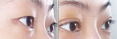 解读割双眼皮：更舒适、安全的美容方式