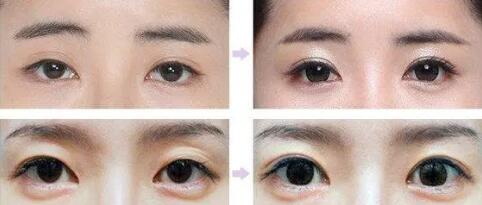 如何治疗色素型黑眼圈
