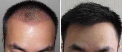 部分头发易断是为什么「为什么植发后有部分头发卷」