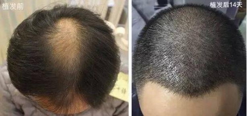 部分头发易断是为什么「为什么植发后有部分头发卷」