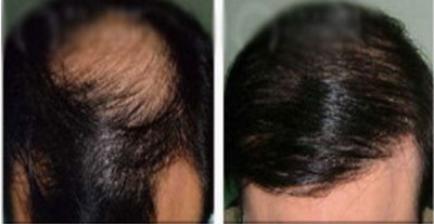 正规毛发移植一般多少钱