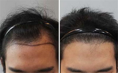 植发后脸多久可以消肿(植发后需要多久可以理发)