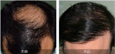 植发一般多久就会长出来(植发一般多久进入脱落期)