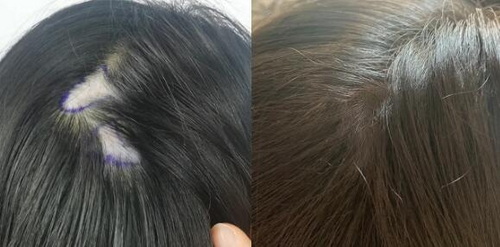植发后的头发能维持多久(植发的头发能维持多久)
