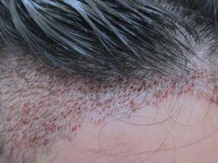 头发移植手术：危险性与疤痕分析