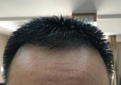 广州发际线植发