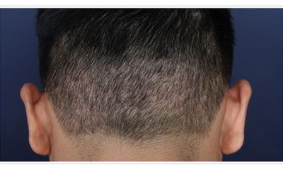 西安种植头发多久能长出来(西安种植头发需要多久能长出来？)
