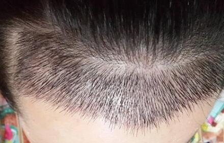 植发后原生发掉了很多「原生发还在掉能植发吗」