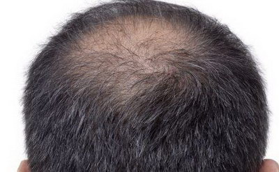 头顶稀疏植发是否需要剃发？