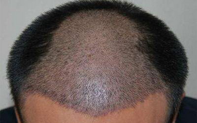 头顶加密植发会影响原生发吗