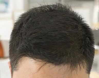掉头发九大因素是什么？