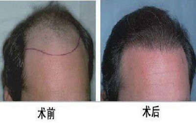 头发手术种植