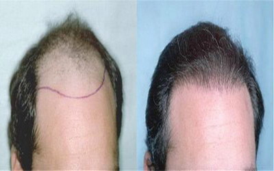 植发的治疗方法(发际线后退的困扰，植发是治疗的好方法)