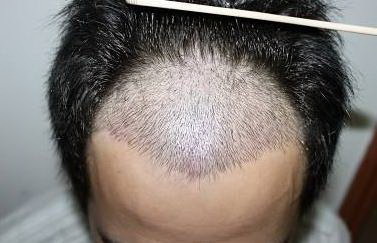 植发能保持多久「植发后能保持多久」