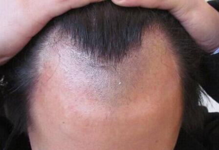 植发后毛囊多久能固定(什么是植发？)