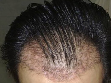 种植头发一般多久能看到效果(种植头发后一般多久能长出来)