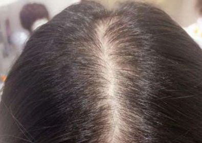 头发种植手术多长时间