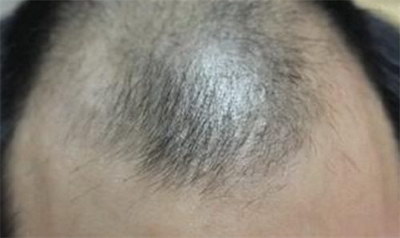 植发手术后多久能长出头发