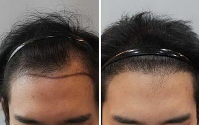 头发种植有副作用吗？如何预防并发症？