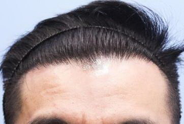 上海疤痕植发一般多少钱