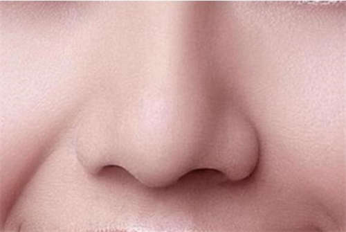 做肋骨隆鼻术的副作用!隆鼻血痂拆线未?